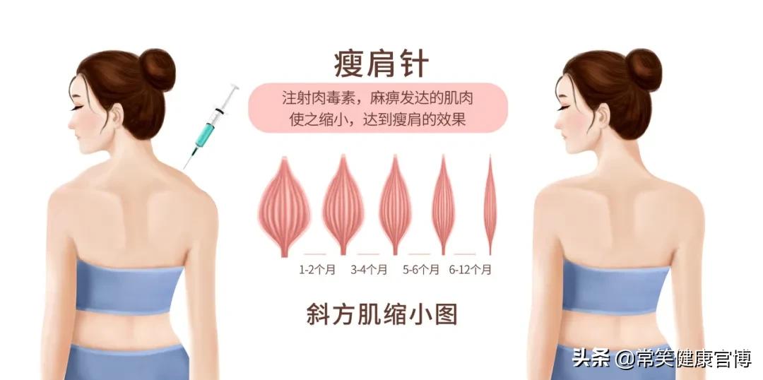 瘦肩针和瘦肩针一样么,瘦肩针30天效果图片