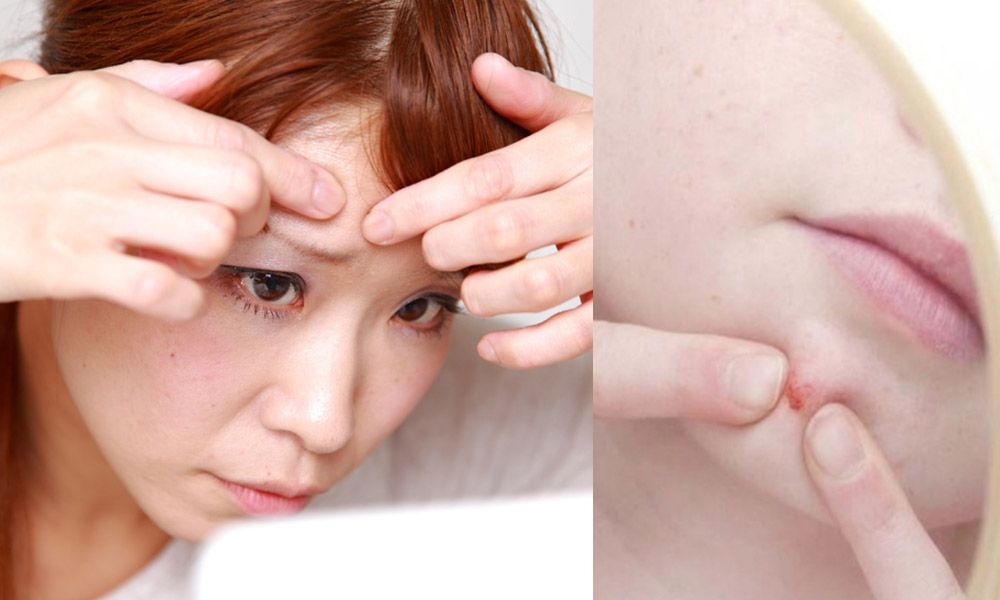 暗疮最好的消除方法 (暗疮印最佳治疗方法)