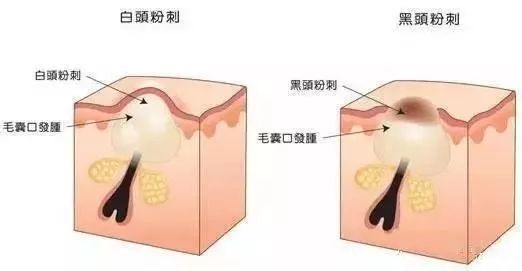 教你一招搞定痘痘告别烦人痘印,教你一招痘痘全消掉