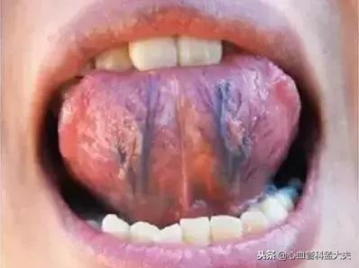 身上的青筋突然很明显是什么原因,身上青筋凸显可能是4种疾病