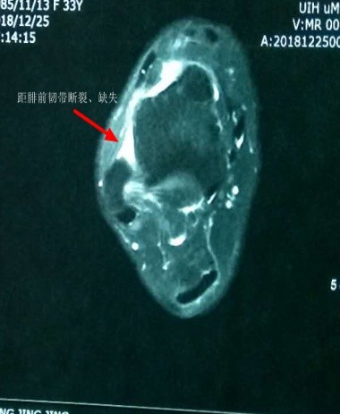 踝关节扭伤打绷带的图片,踝关节扭伤消肿治疗方法