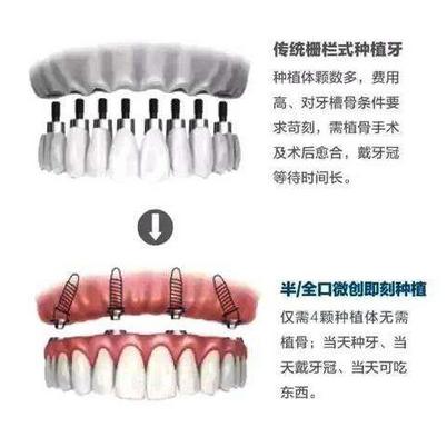 缺失半口牙怎么种植,半口牙缺失不种植还有其它办法吗