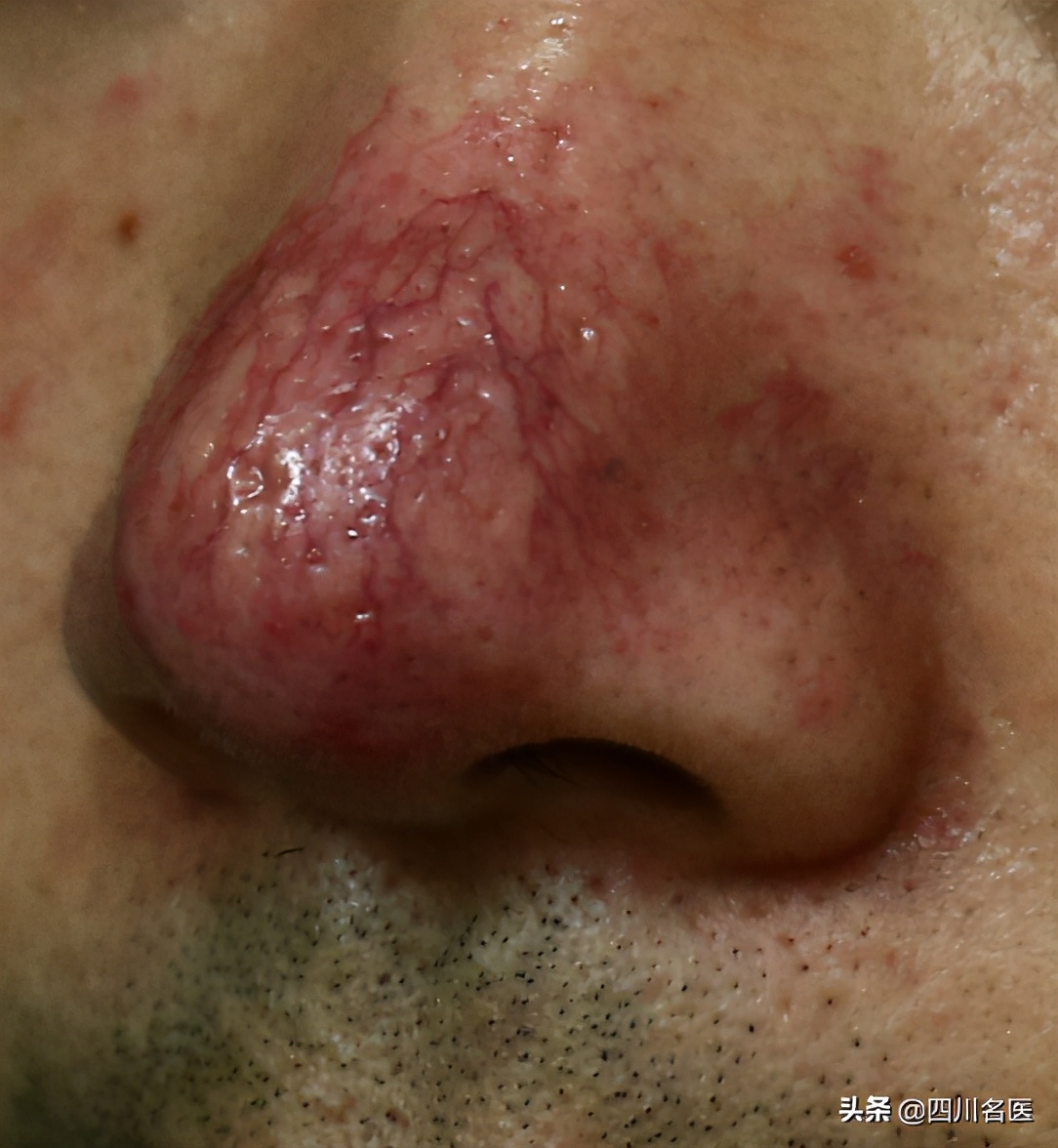 一把年纪了还总长痘,一把年纪了脸上还爆痘