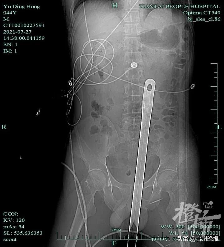 太吓人！台州男子高处跌落，钢管扎进身体32厘米，体外还留着1米长……