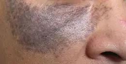 脸部斑的种类及如何辨别,一招教你怎样辨别脸上的斑