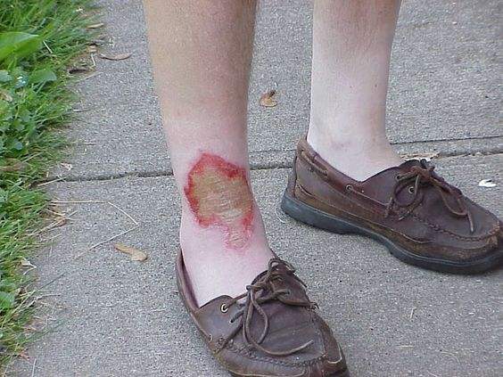 烧伤后伤口结痂特别痒痒几天能好,烧伤后一般要痒多久