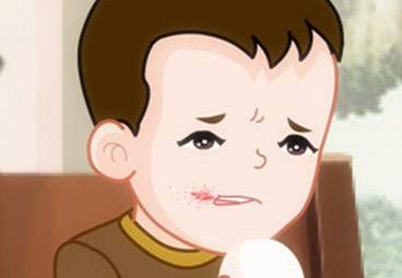 小孩上火烂嘴角最快治疗方法,因上火而烂嘴角吃什么药好呢