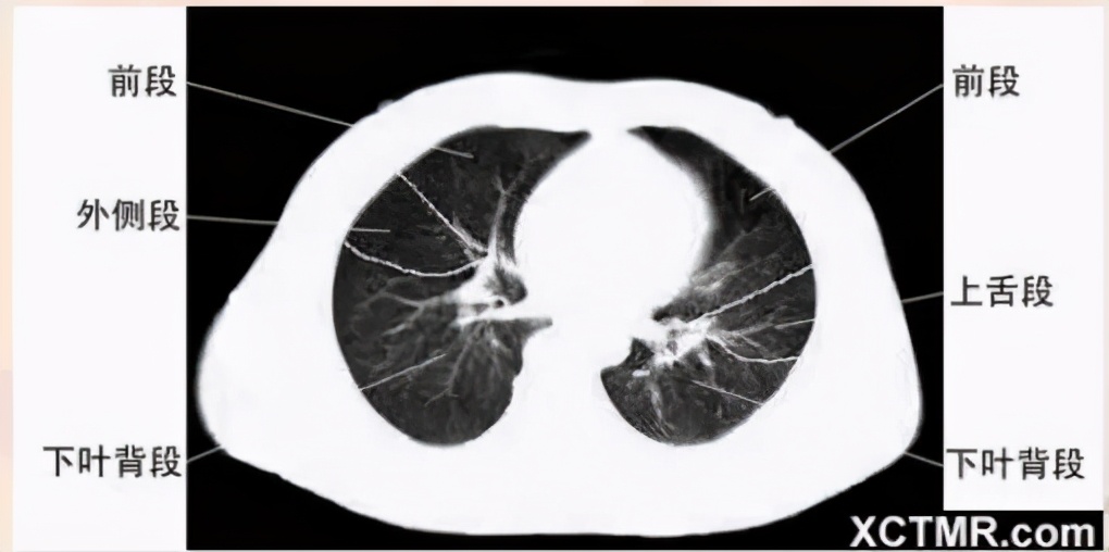 女性盆腔ct断层解剖结构图,女性盆腔脏器ct解剖