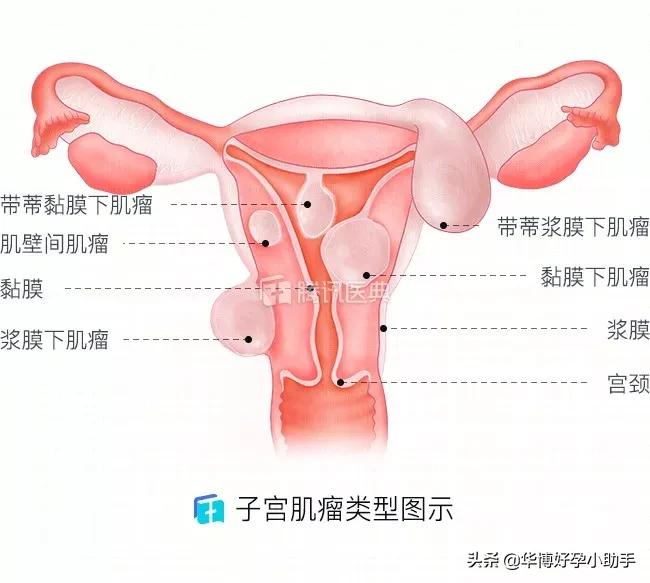 子宫肌瘤是咋把胎儿挤丢的？流产和不孕都是谁的错？备孕必读