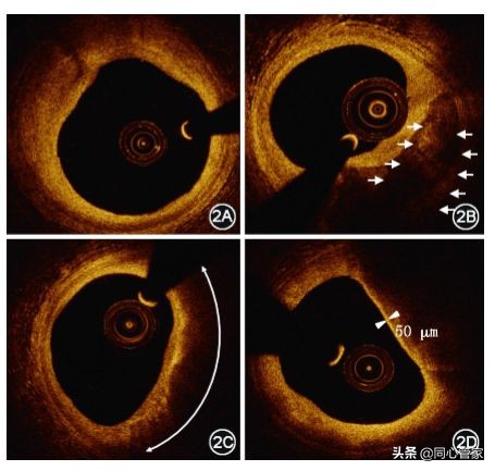 斑块和血栓ct区别,斑块和血栓的超声鉴别