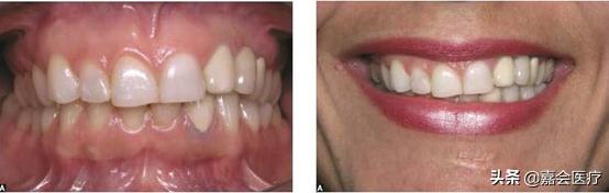 怎么不露齿笑才自然好看,如何笑不露齿笑起来好看的技巧