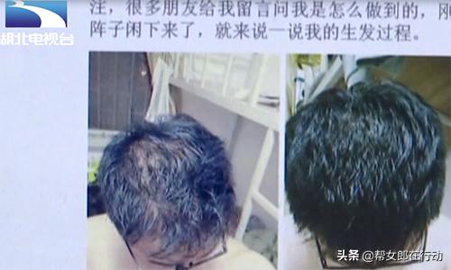 脱发老中医推荐,脱发看中医抓药需要多少钱