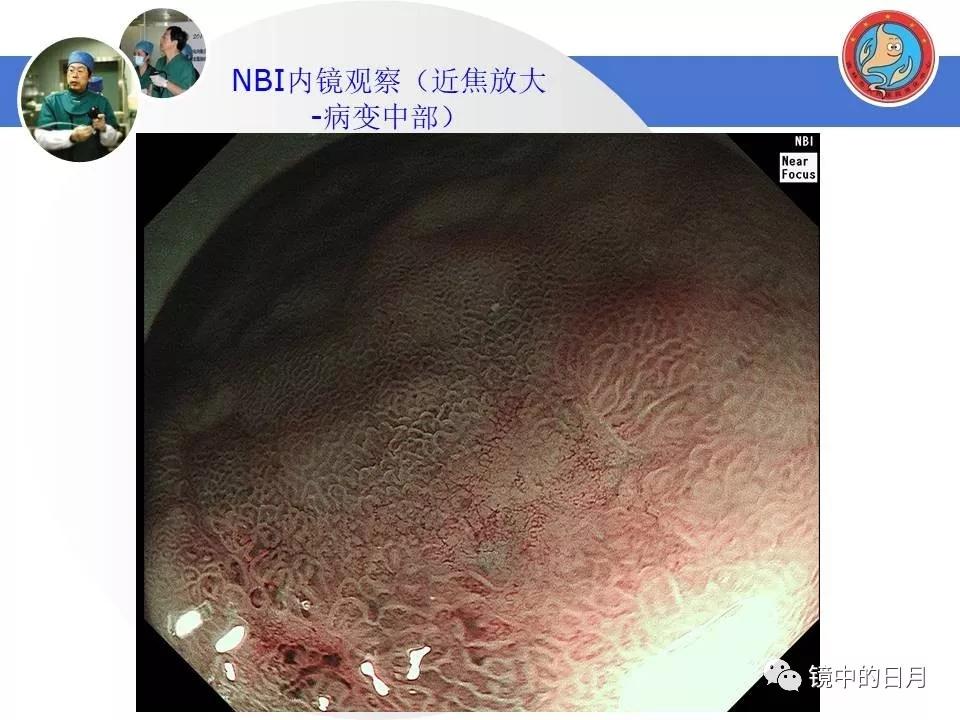 低分化胃癌早期时候做内镜手术吗,早期胃癌内镜手术后追加外科手术