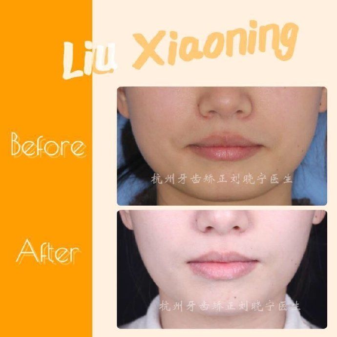 矫正牙齿如何改善露龈笑,矫正牙齿可以改善露龈笑吗