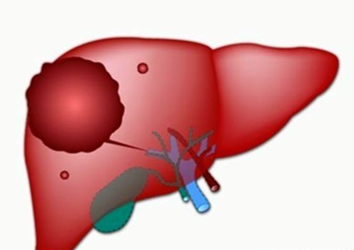 肝脏结节是恶性的吗,肝脏结节恶性的几率大吗