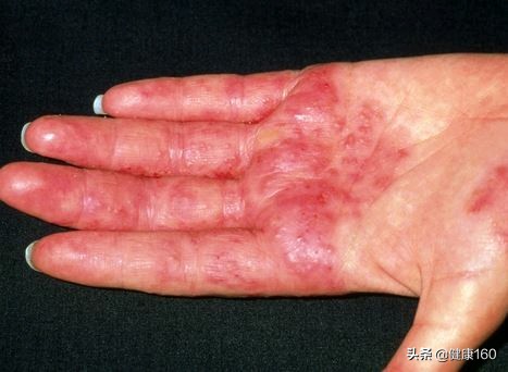 手脱皮考虑什么诊断,手脱皮有哪几种类型