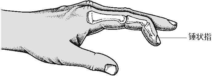 25%的人手臂中都会缺少一块肌肉：看看你也是这样吗？