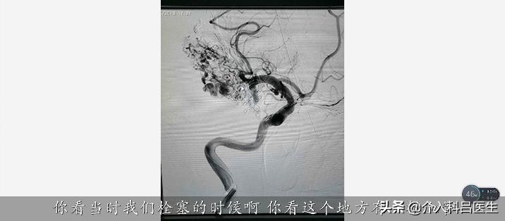 50岁大姐出车祸,50岁大姐脑出血康复成功案例