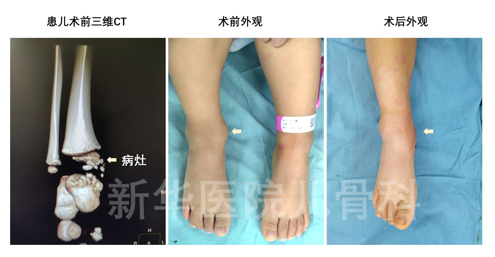 儿童髋部恶性肿瘤有什么表现,儿童脑部肿瘤引起的走路不稳视频