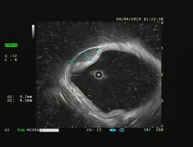 消化内镜发展现状,上消化道超声内镜临床应用