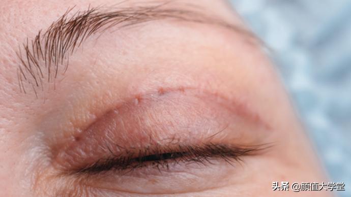 为什么做了双眼皮还不好看,做双眼皮前问清楚自己这三个问题