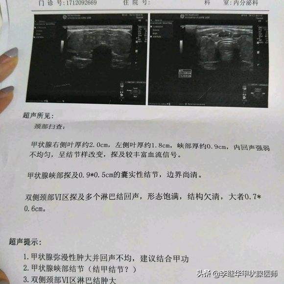 甲状腺结节血流信号怎么看,甲状腺结节报告怎么看
