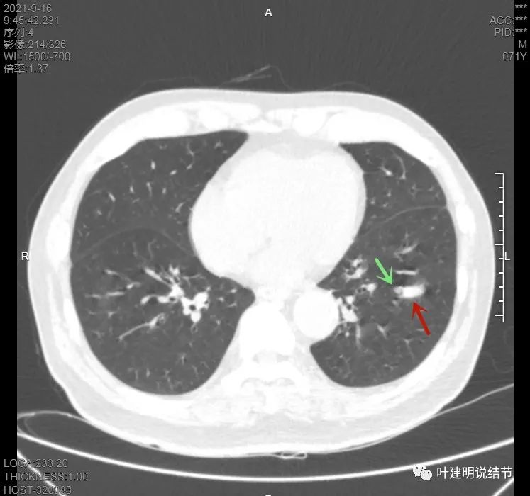 肺上有实性结节6mmx5mm是什么原因,肺上有1.7x1.8的实性结节该怎么办