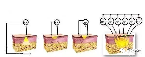 射频仪器对人体的伤害,射频仪危害