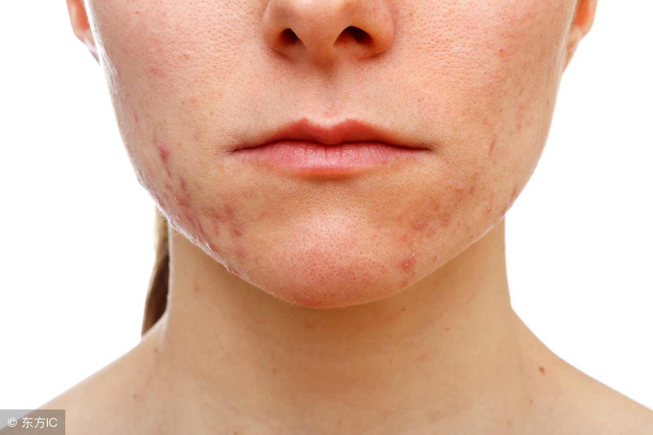 口服地塞米松多久才会出现副作用,长期使用妥布霉素地塞米松副作用