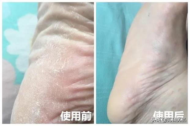 爽炸了!干丑裂的脚皮,一张完整撕掉,敢跟婴儿比姣嫩!