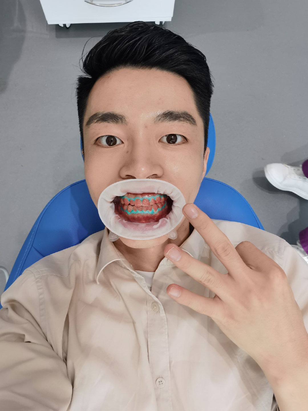 牙医的牙齿美白过程,医生推荐的牙齿美白