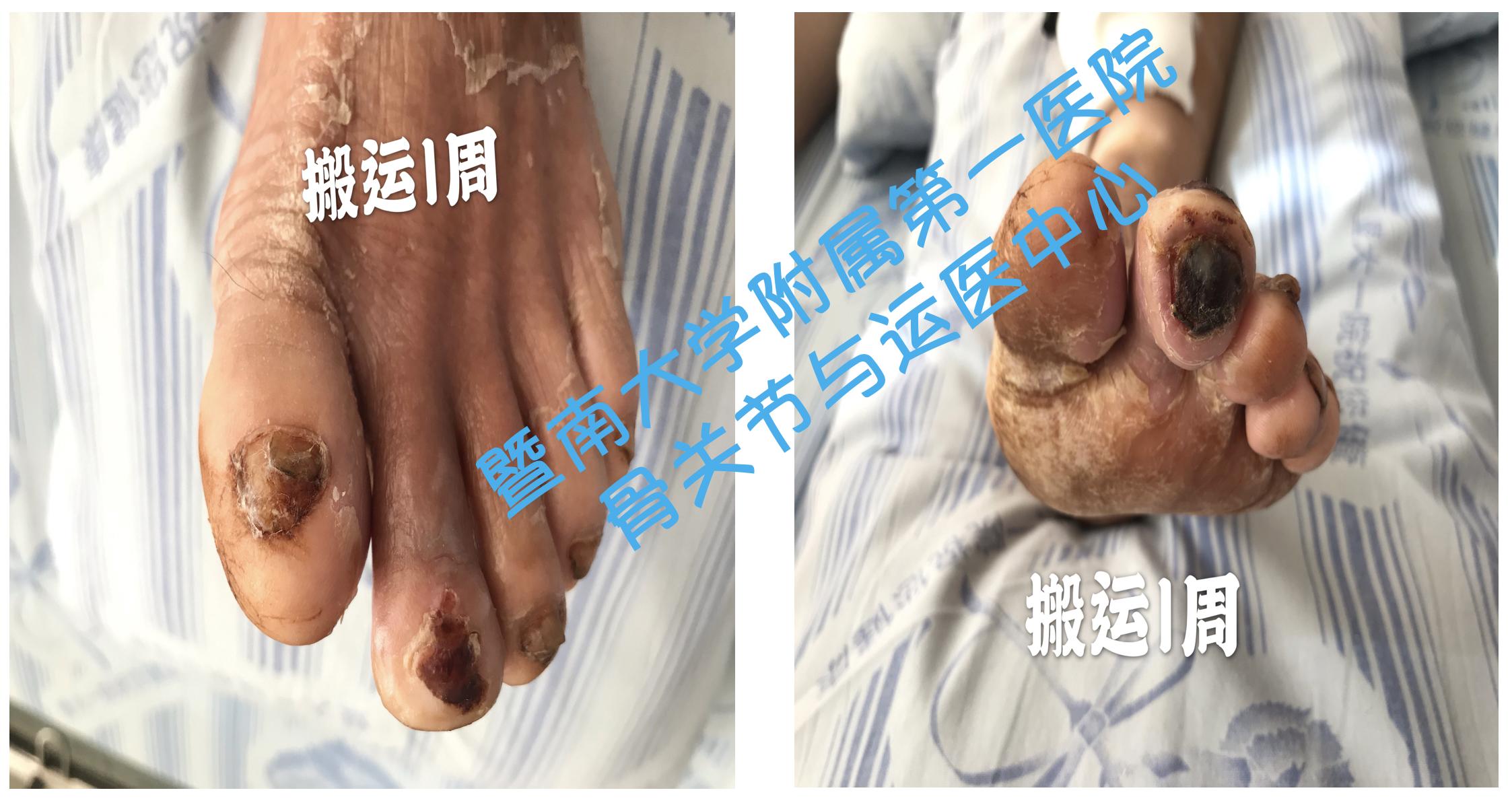 糖尿病足截肢后怎么长肉快,糖尿病足不截肢的最新疗法