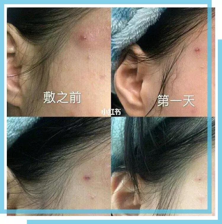 如何有效的祛痘印医美面膜,消炎祛痘的医美面膜