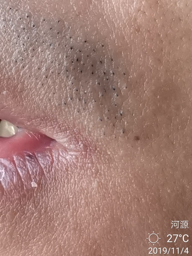 冬季多发口角炎（烂嘴角），中医怎么治？