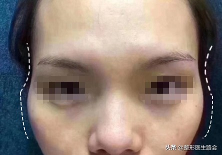 颧骨内推和填充玻尿酸哪个好,太阳穴凹陷颧骨突出填充还是内推