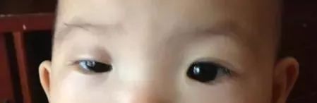 宝宝双眼不一样大,宝宝眼睛大小不一样什么原因