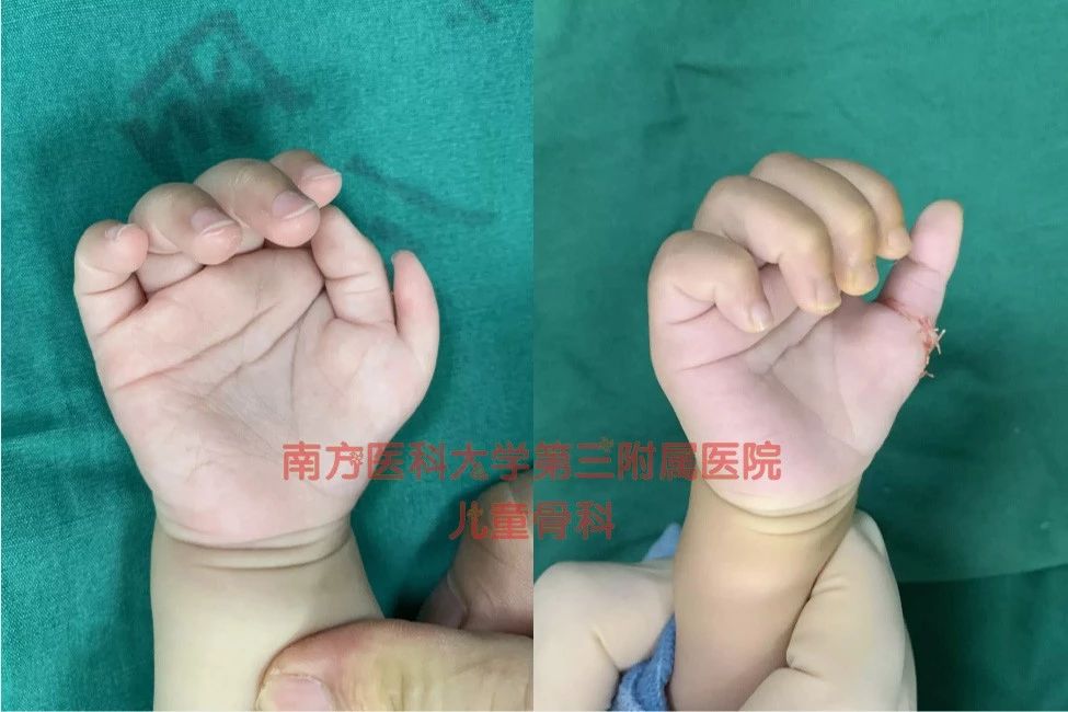 宝宝割并指手术要几天,十几年的缝针手术疤痕怎么淡化