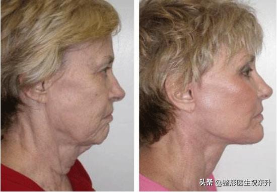 40岁做拉皮手术会年轻几岁,年龄大了做拉皮手术图片