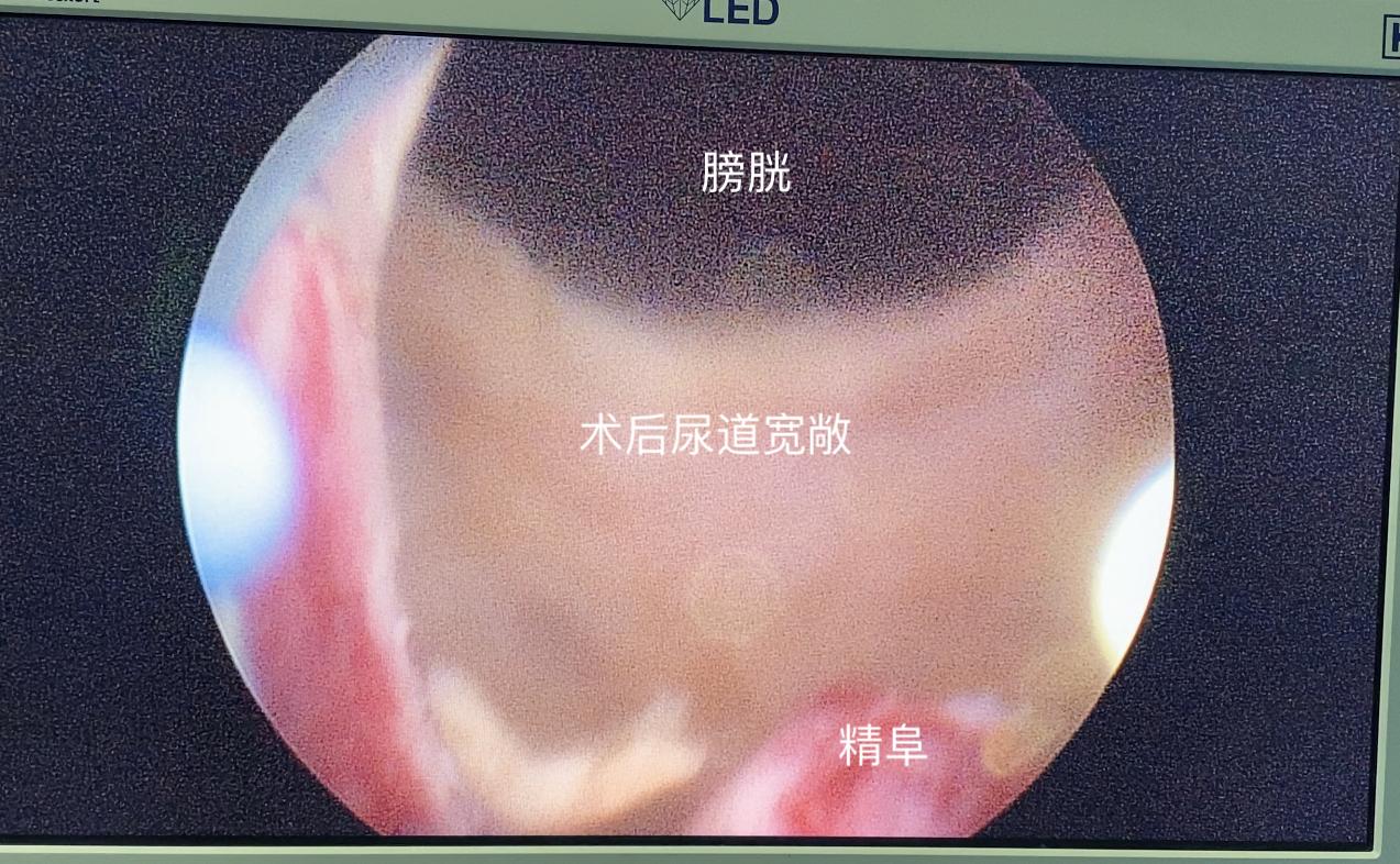 前列腺增生手术后尿道狭窄怎么办,前列腺增生微创术后有哪些并发症