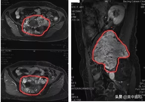 罕见血管瘤8年间4次复发转移，如何拆除这颗“不定时*弹炸**”？