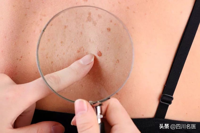 指甲上出现一条细线是怎么回事,女子指甲多出一条线为保命要截肢