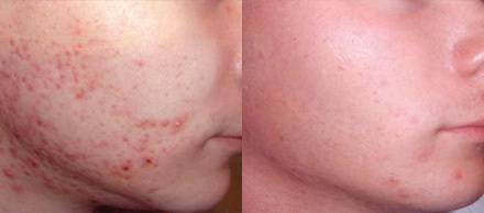 痘肌用壬二酸洗面奶,拯救你的痘痘