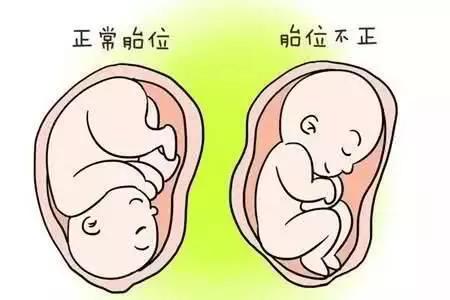 一般胎位不正是什么原因引起的,什么样的原因会导致胎位不正