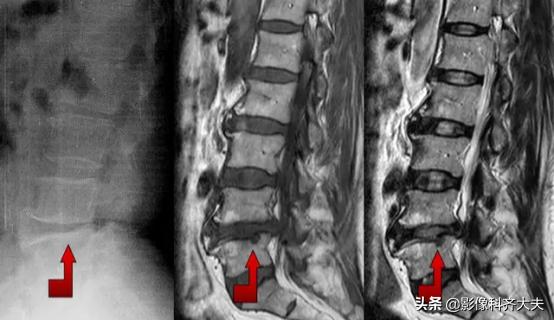 腰椎间盘突出是什么,腰椎间盘突出和腰间盘突出有区别吗