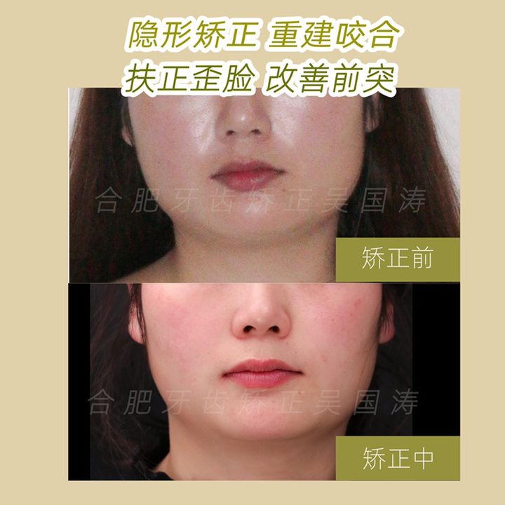 牙齿正畸下颌磨牙,牙列拥挤伴牙齿前突矫正案例