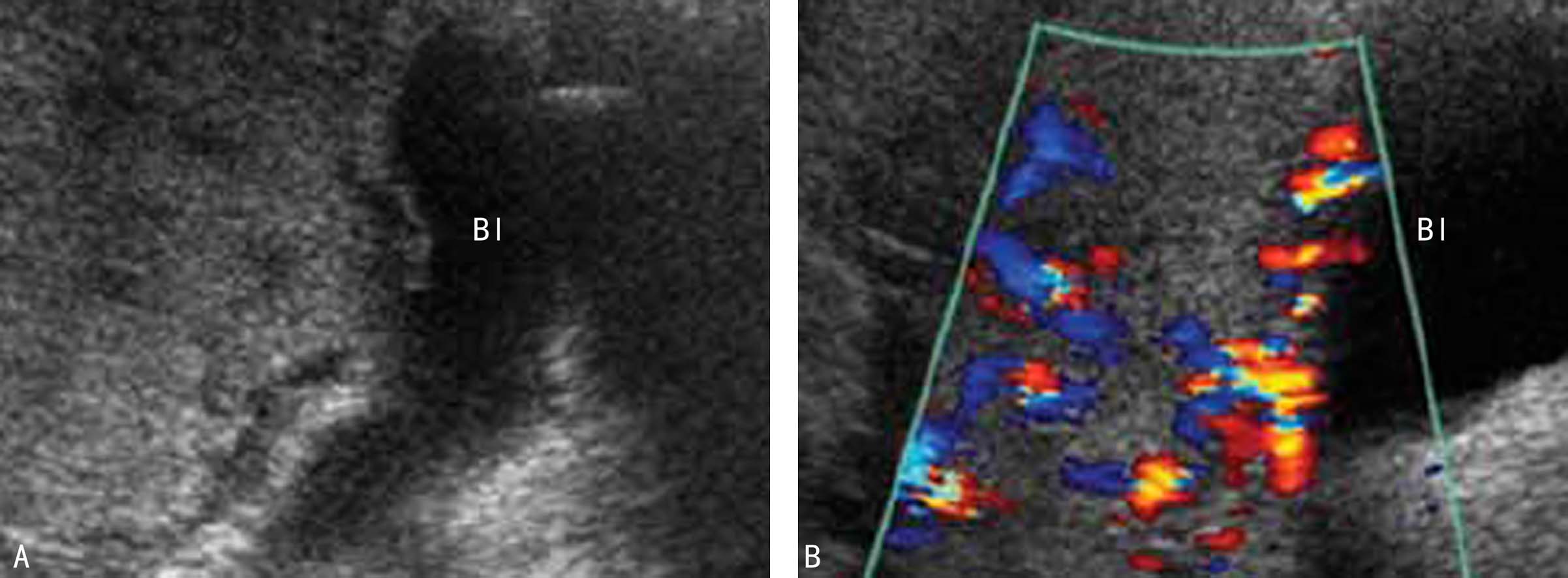 胎盘异常的超声表现,从超声影像学报告单看胎盘好坏