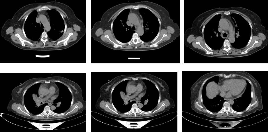 鍖荤敓鏃犳硶鍒ゆ柇缁撹妭鐥呰繕鏄粨鏍哥梾,鏈夎偤缁撴牳鐥呭彶鍗佸嚑骞存煡鍑鸿偤缁撹妭