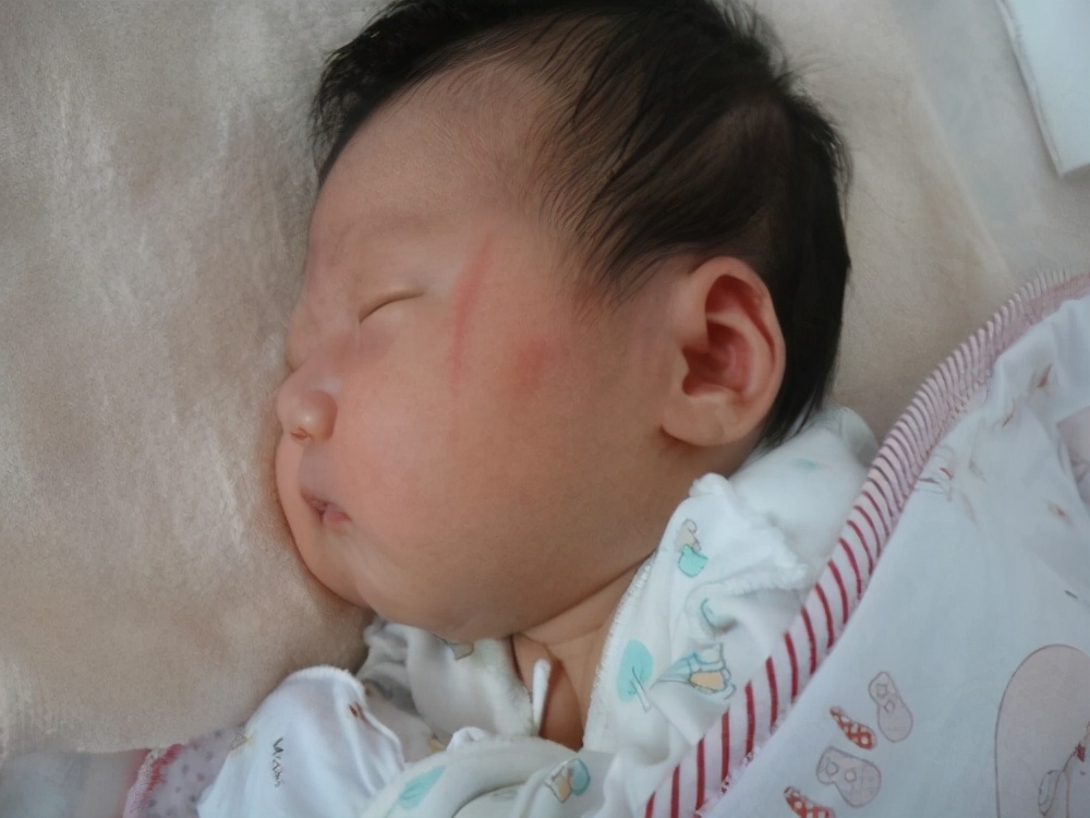 宝宝总是把自己挠破,宝宝老是挠破怎么办