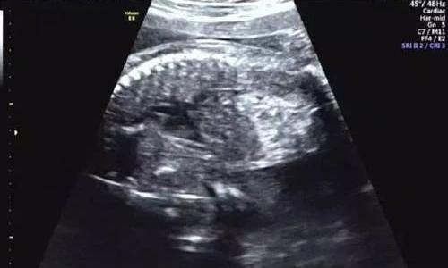 胎儿肠管区域多发斑点状强回声,胎儿肠管回声增强是什么引起的