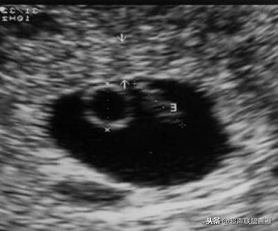 3毫米卵黄囊未见胎芽正常么,40多天的卵黄囊